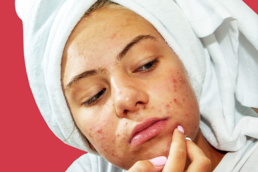 A teenage girl with facial scabs, pimples, picking at her skin against a red background
